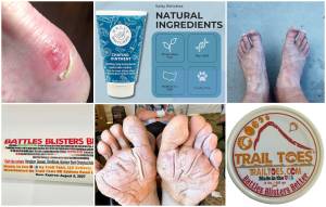 Η Φροντίδα των Ποδιών στις Υπεραποστάσεις: Πρόληψη, Εμπειρία και Νοοτροπία (Πρώτο Μέρος)!