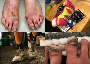 Η Φροντίδα των Ποδιών στις Υπεραποστάσεις: Πρόληψη, Εμπειρία και Νοοτροπία (Δεύτερο Μέρος)!